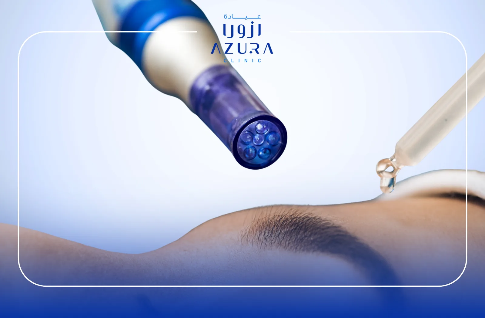 Microneedling+PRP for Skin Rejuvenation