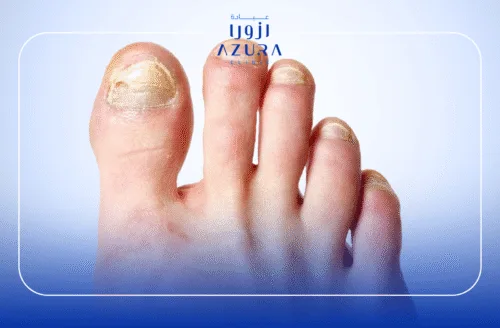 Nail fungus treatment