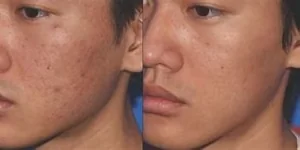 scar reduction with microneedling+prp