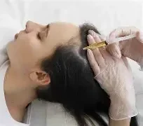 prp hair loss treatment