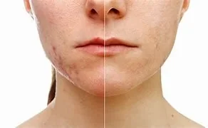 Scar Reduction with PRF