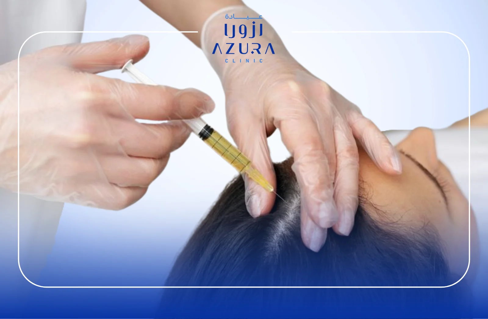 PRF Hair Loss Treatment: 5 Powerful Benefits of This Natural Hair Growth Solution