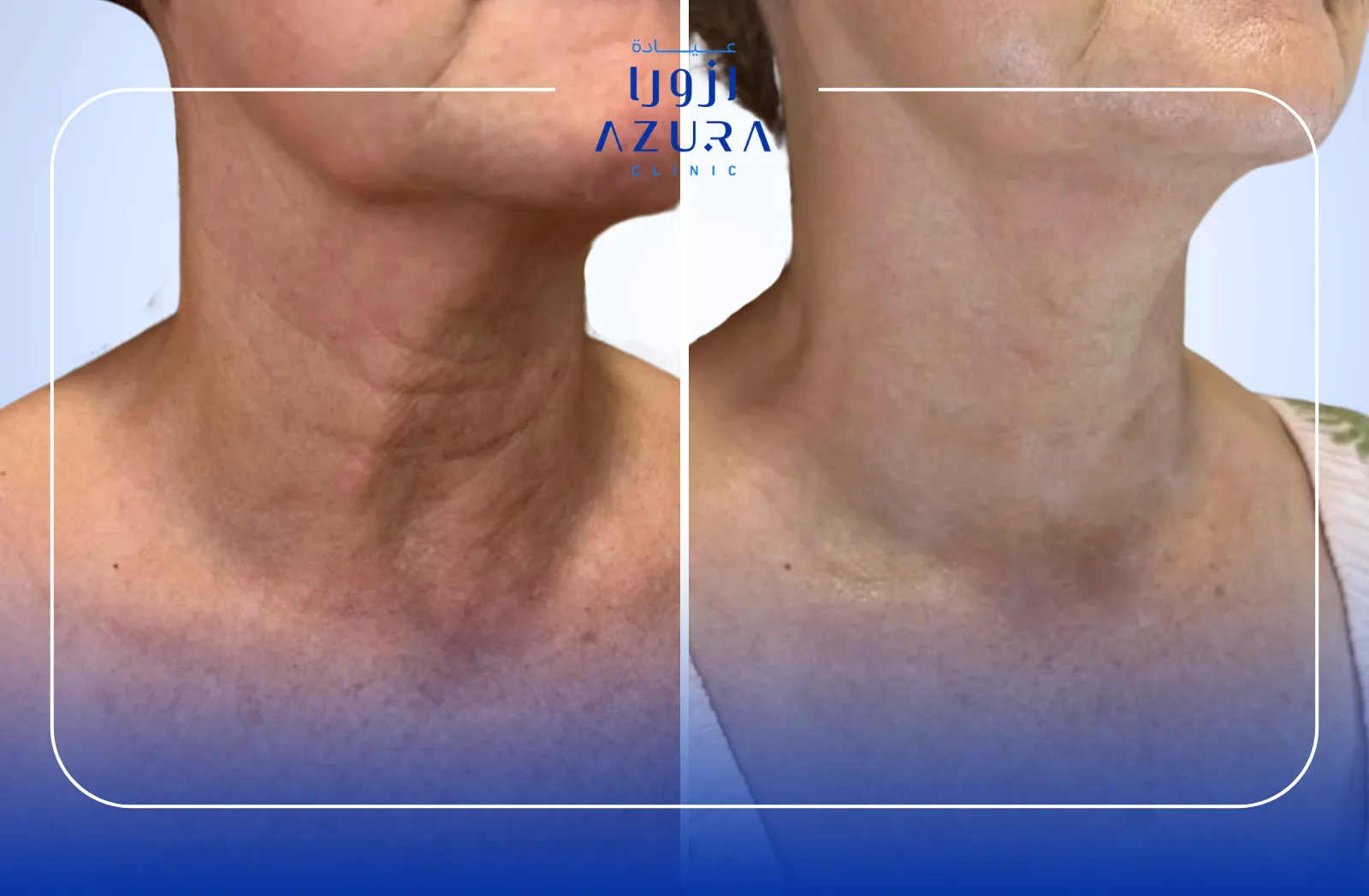 PRF Skin Rejuvenation
