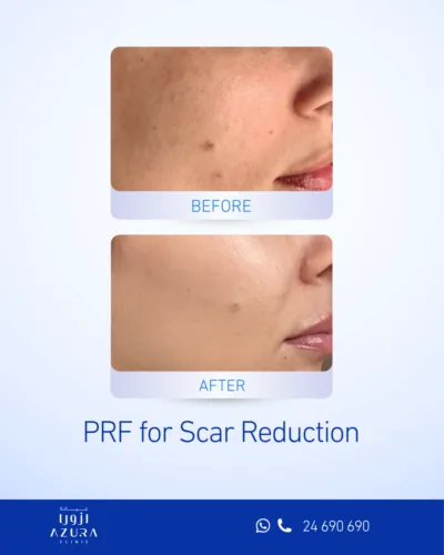 Before and after PRF scar reduction treatment on the cheek, showing smoother skin texture at Azura Clinic Muscat