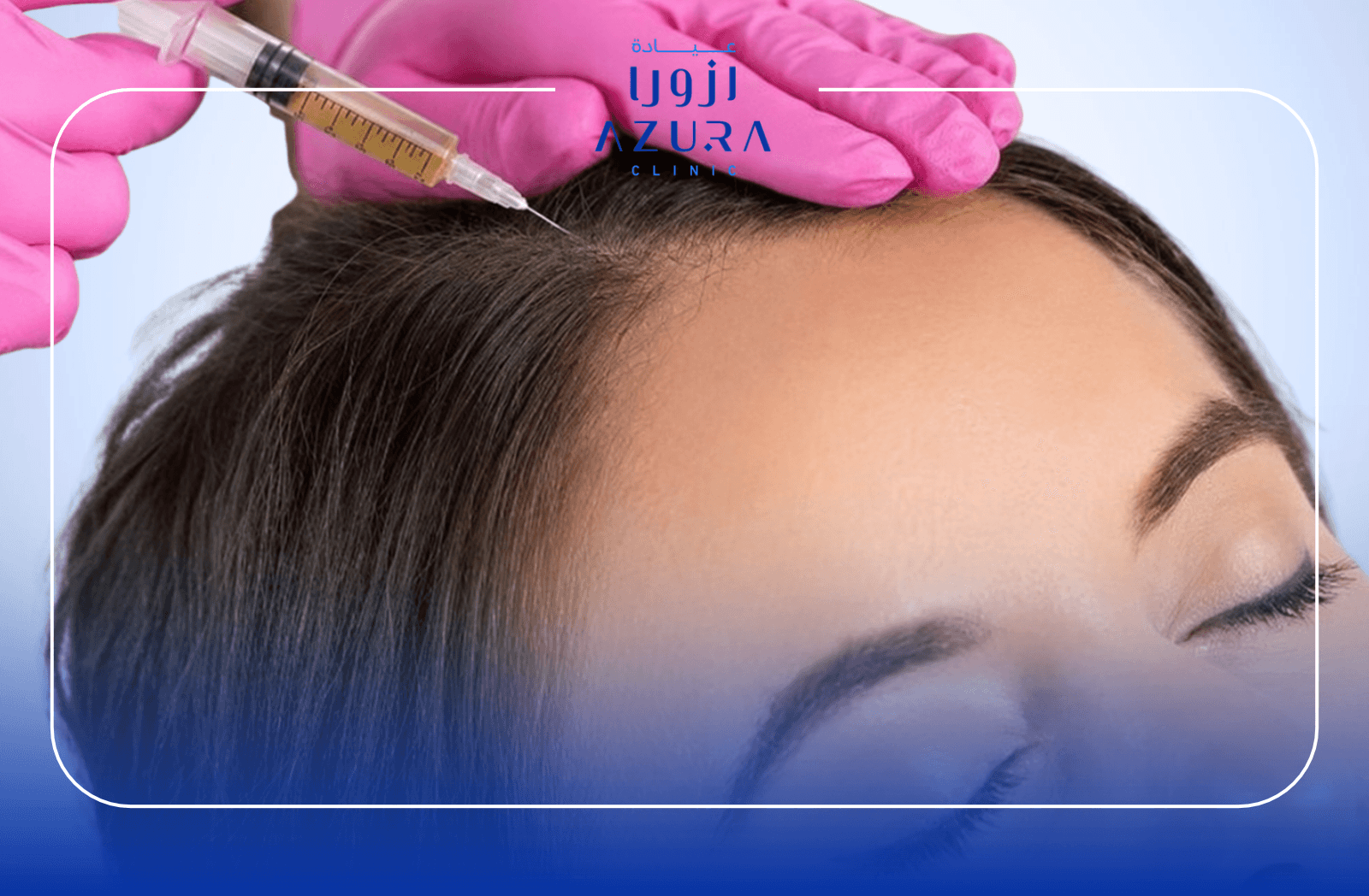 PRF injection treatment for hair loss and thinning hair at Azura Clinic