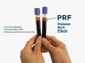 scar reduction with prf