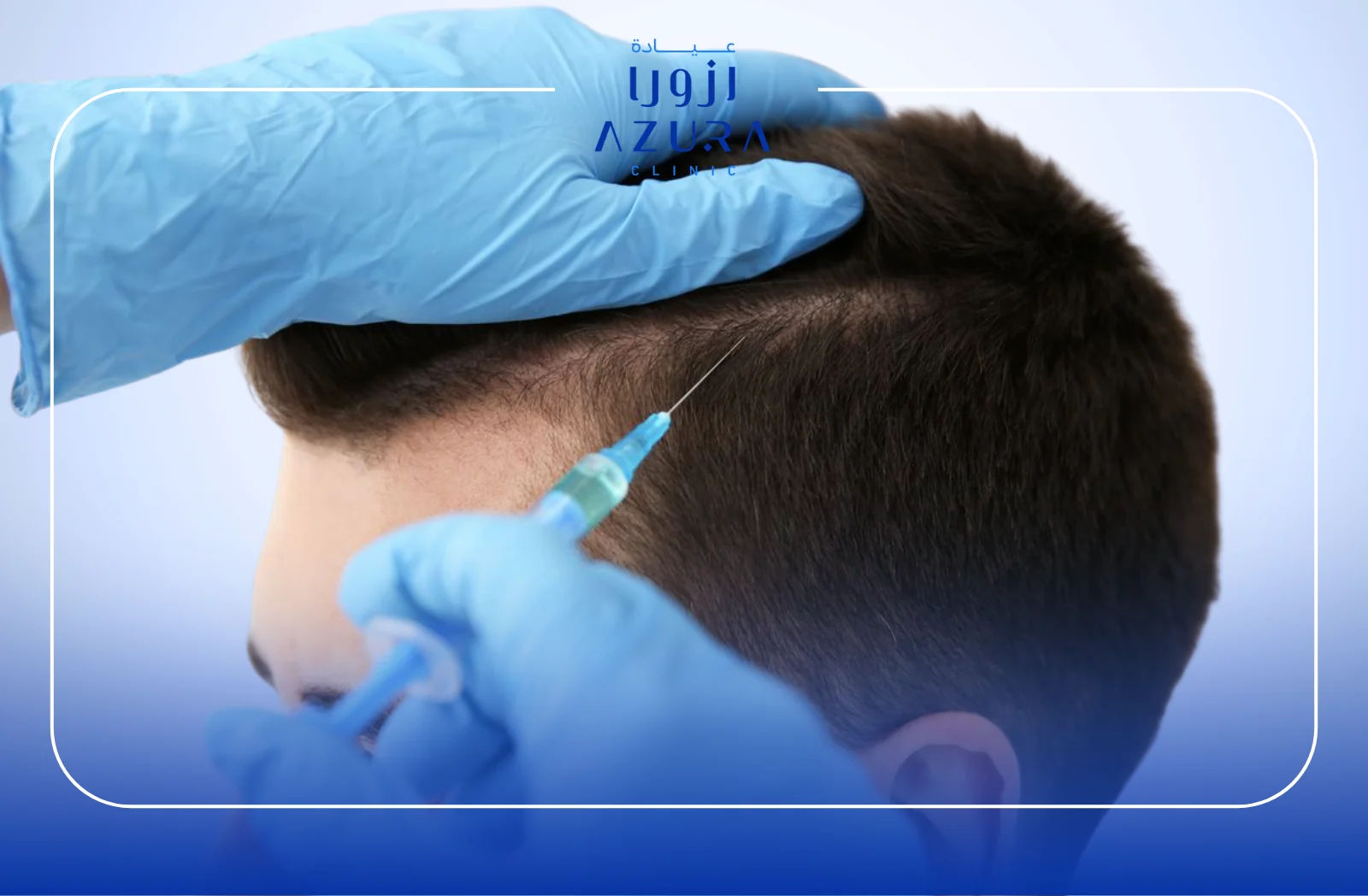 PRP Hair Loss Treatment: 7 Powerful Reasons to Try This Natural Solution Today