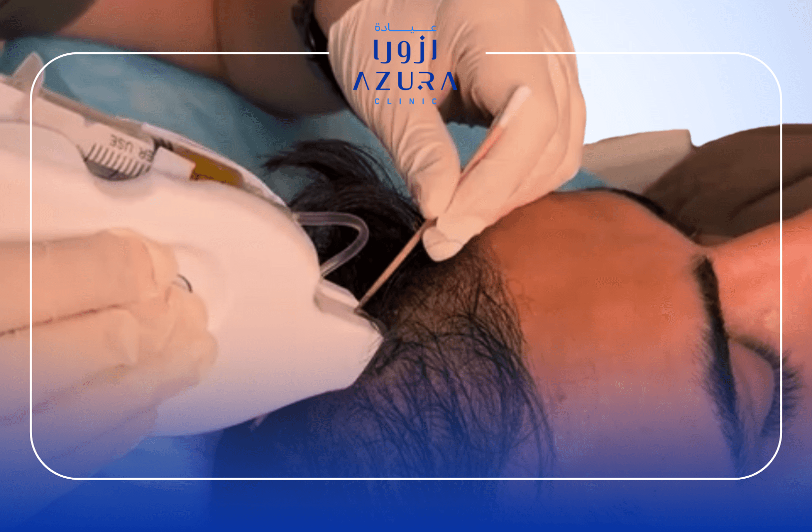 PRP hair treatment to support hair growth and strengthen weakened hair follicles at Azura Clinic in Muscat.
