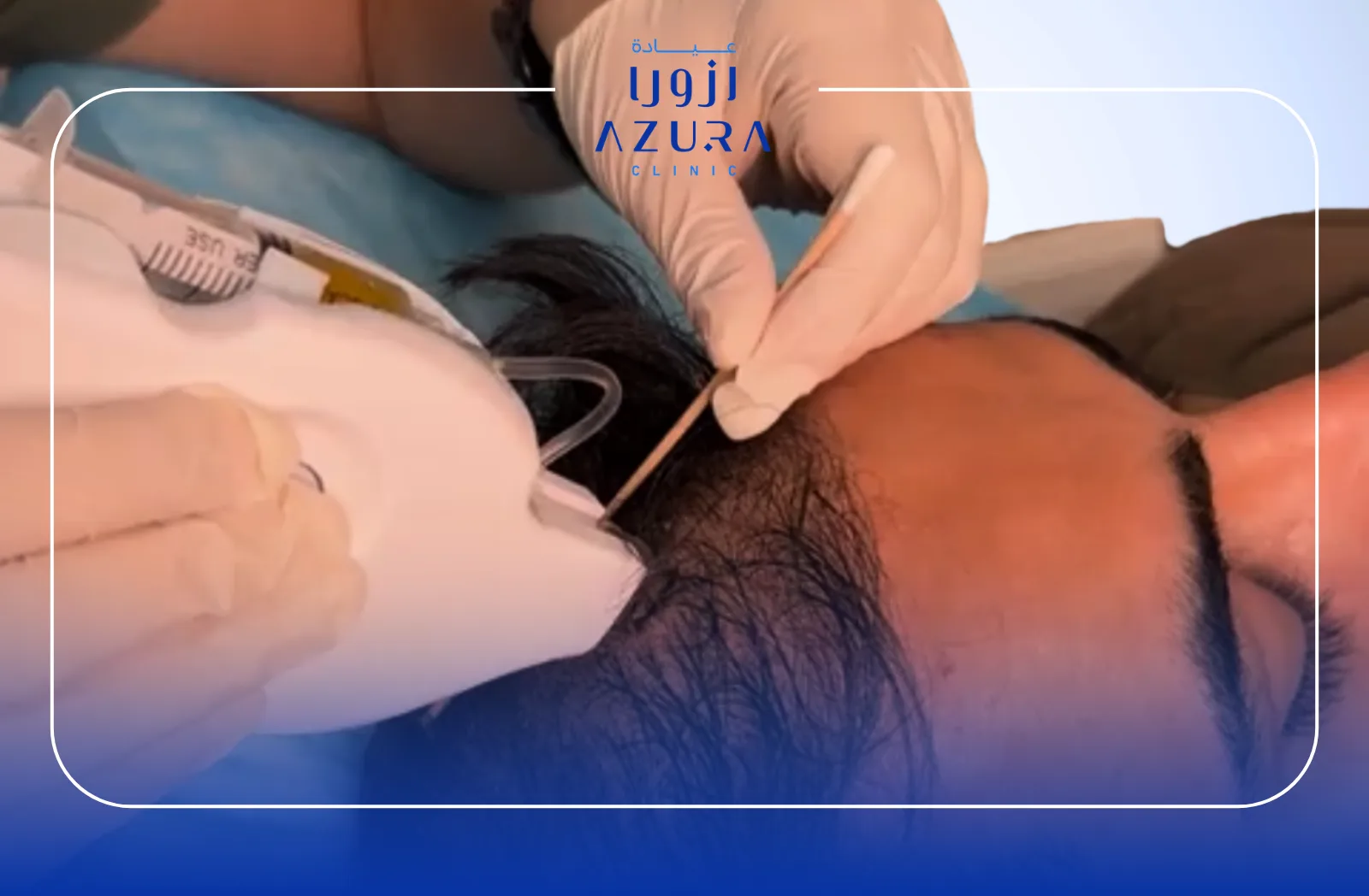 PRP hair treatment to support hair growth and strengthen weakened hair follicles at Azura Clinic in Muscat.