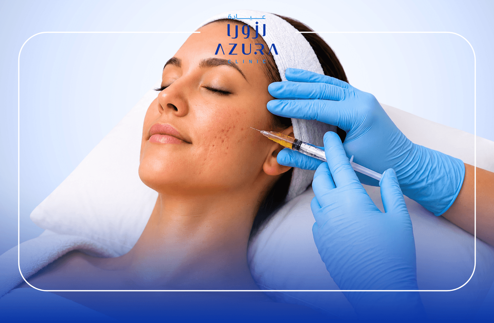 PRP scar reduction treatment to improve skin texture and the appearance of scars