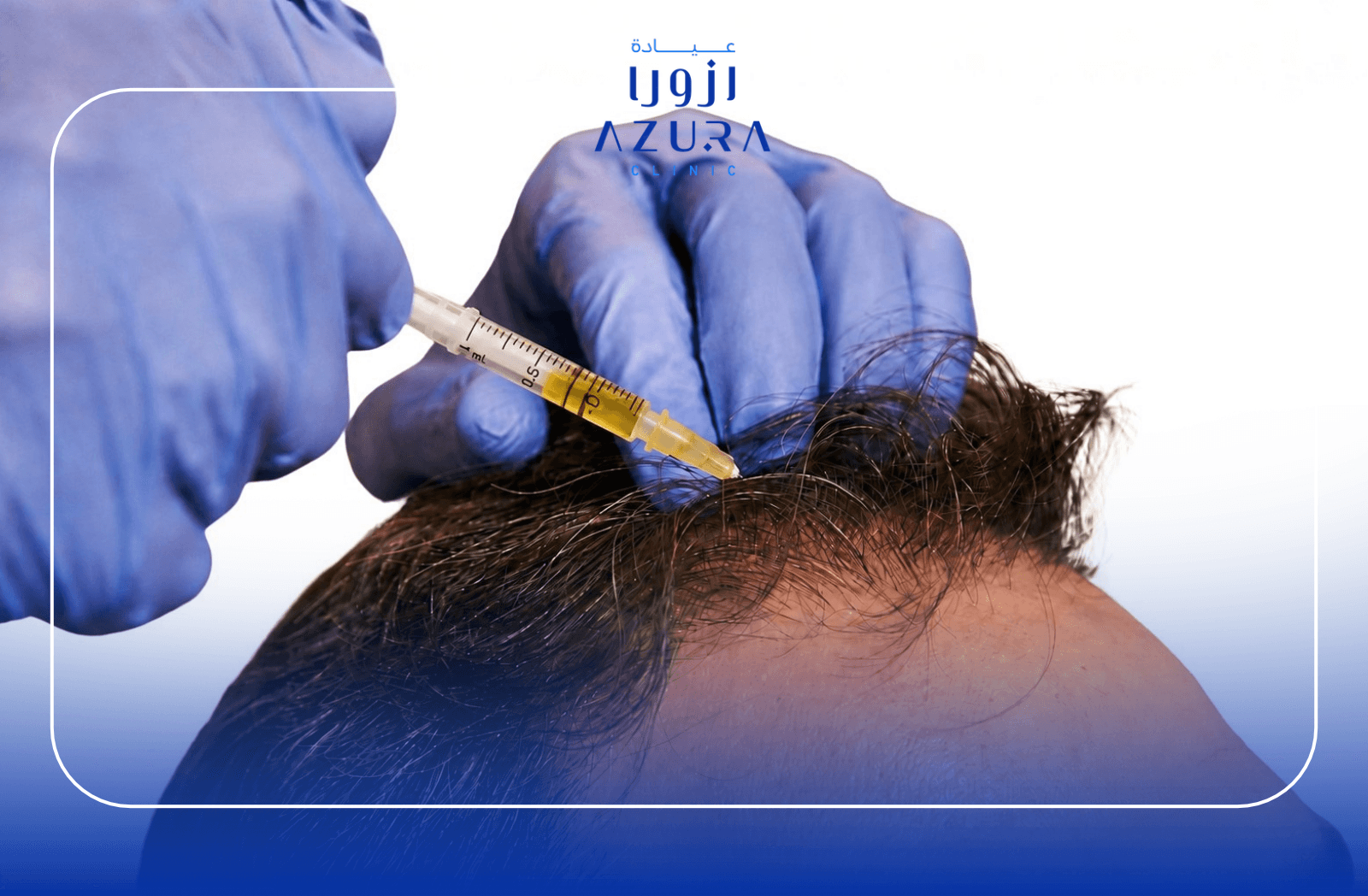 PRP and mesotherapy injection for hair loss treatment at Azura Clinic