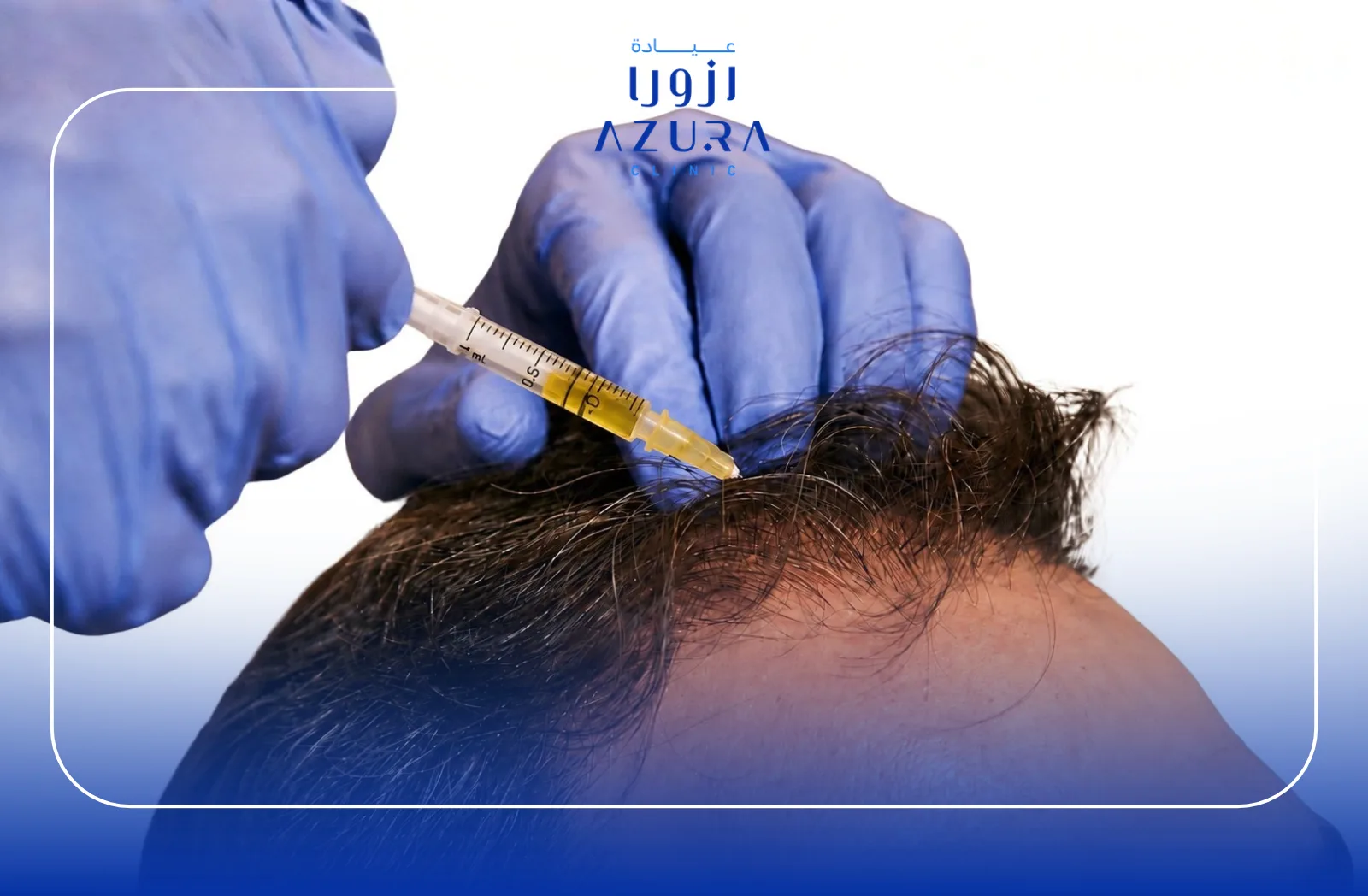 PRP and mesotherapy injection for hair loss treatment at Azura Clinic