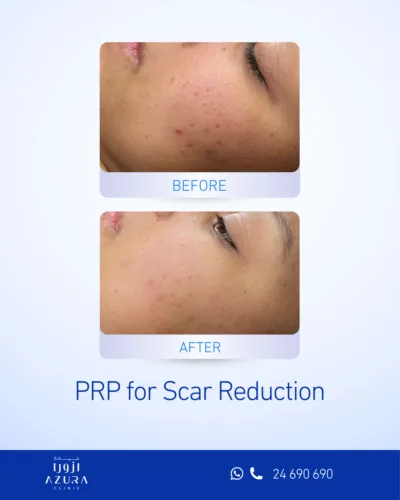 Before and after PRF platelet-rich plasma treatment for acne scars on the cheek at Azura Clinic Muscat