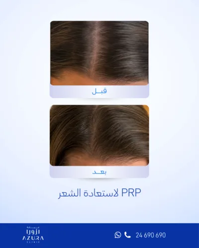 علاج PRP لاستعادة الشعر في عيادة أزورا بمسقط لدعم نمو الشعر وتحسين كثافته وتقوية الشعر المترقّق.