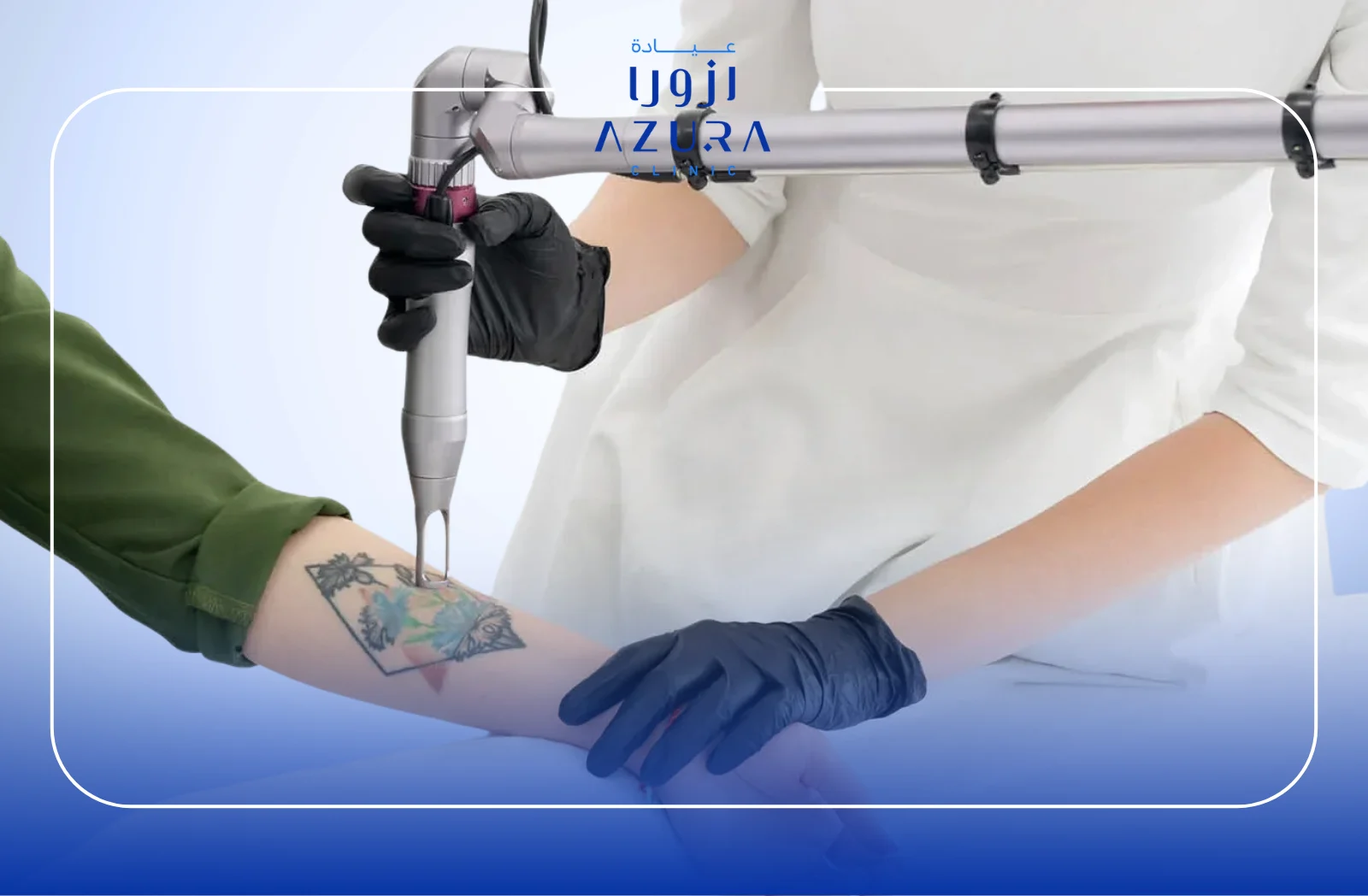 Q-Switch Laser Tattoo Removal: 9 Essential Facts for Safe and Effective Tattoo Fading