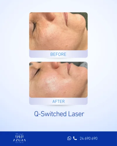 Q-Switched Laser treatment at Azura Clinic Muscat to help improve pigmentation, uneven skin tone, and overall skin clarity.