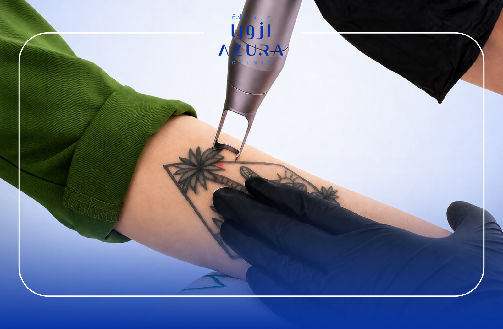 Q-Switched laser tattoo removal treatment at Azura Clinic Muscat Oman