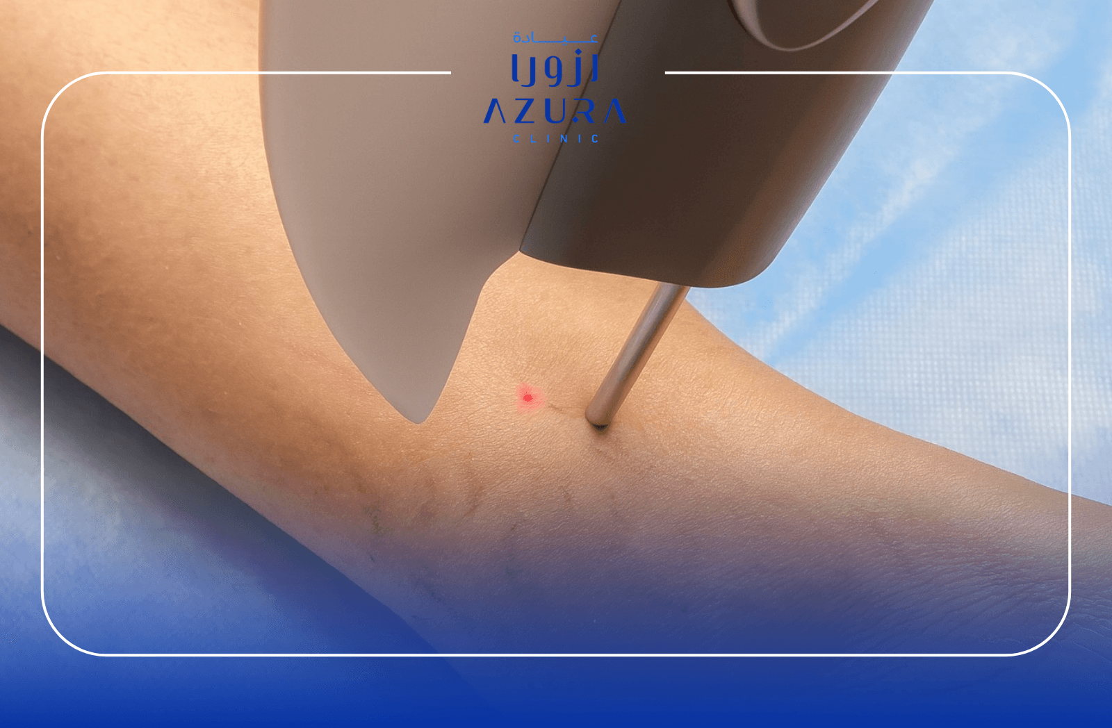 Laser treatment for varicose veins at Azura Clinic in Muscat, Oman
