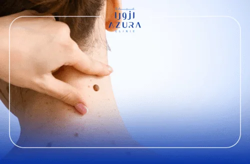 Wart,Skin Tag and Mole Removal
