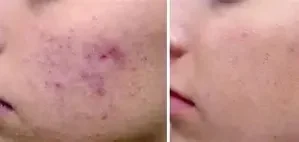 تقليل الندبات بليزر فوتونا الفراكشنال