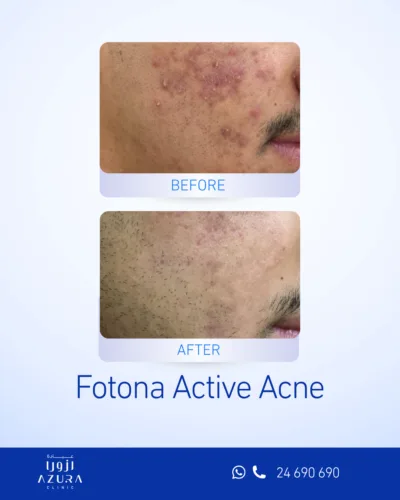 Fotona Active Acne treatment before and after facial skin results at Azura Clinic