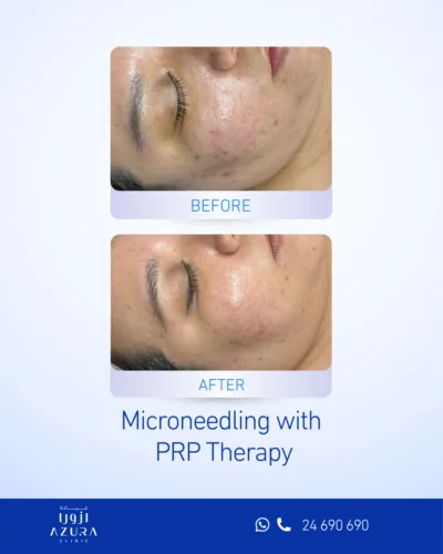 Before and after microneedling with PRP treatment on the face, showing reduced acne lesions and smoother skin texture