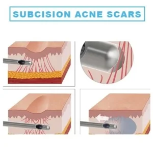 subcision