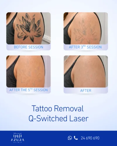 Tattoo Removal Q-Switched Laser before and after results at Azura Clinic