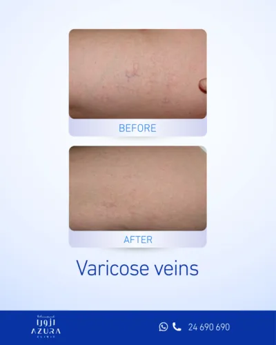 Varicose veins treatment before and after results at Azura Clinic