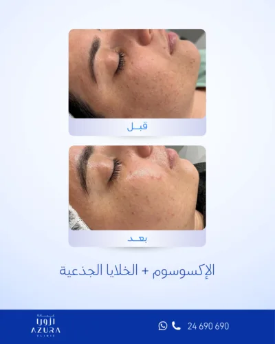 علاج الإكسوسوم + الخلايا الجذعية في عيادة أزورا بمسقط لدعم تجديد البشرة وتحسين الترطيب والملمس والنضارة.