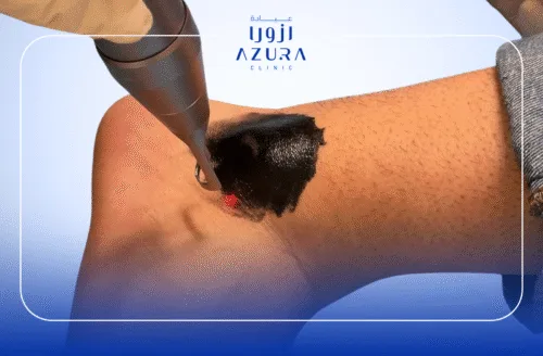 Ankle Rejuvenation with Carbon Laser