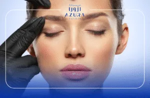 Brow Lift 3 Brow Lift