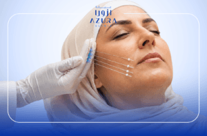 Midface Thread Lift