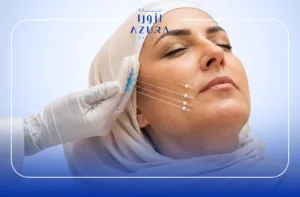 Midface Thread Lift