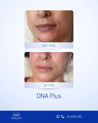 Before and after results of DNA Plus skin treatment at Azura Clinic Muscat