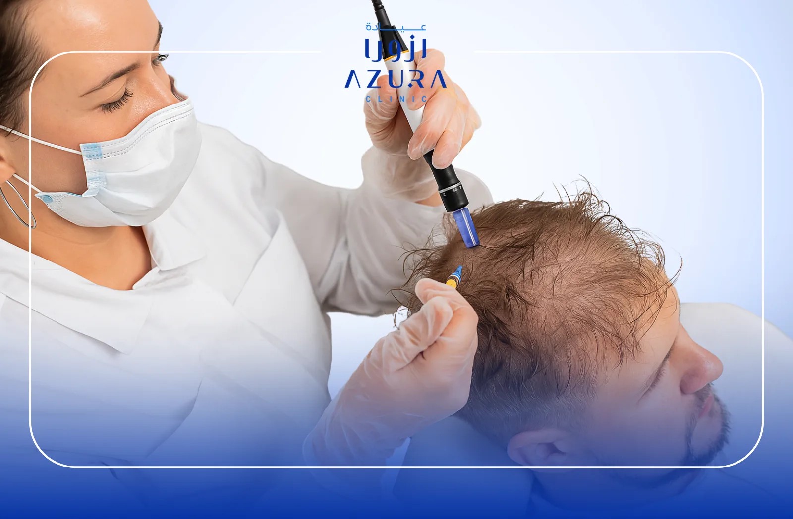 Dermapen+Mesotherapy for Hair Loss