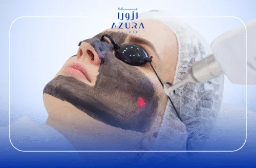 Face Rejuvenation with Carbon Laser