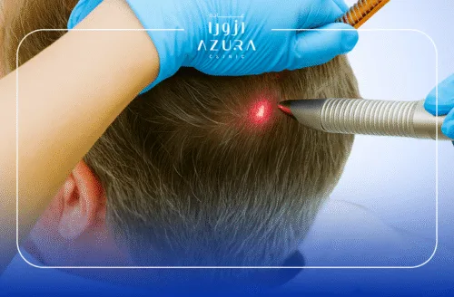 Fotona Hair Restart + Hair Exosome (ACE)