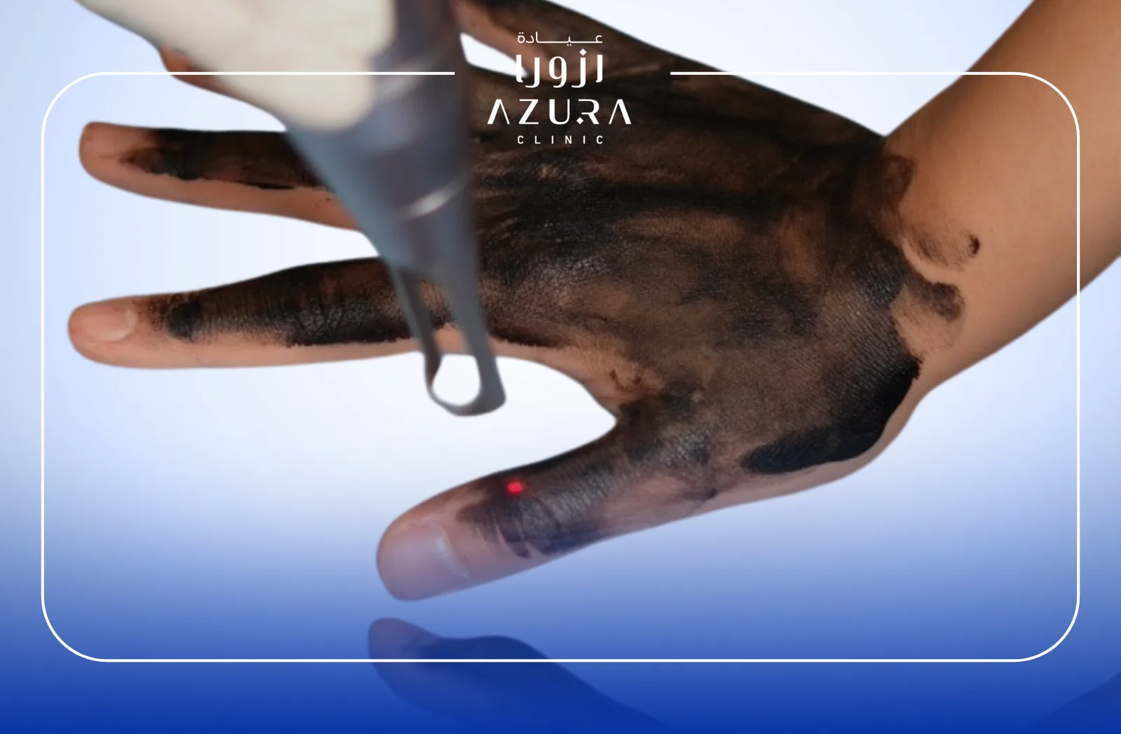 Hand Rejuvenation with Carbon Laser