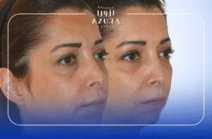 Hyaluronic Acid Treatment