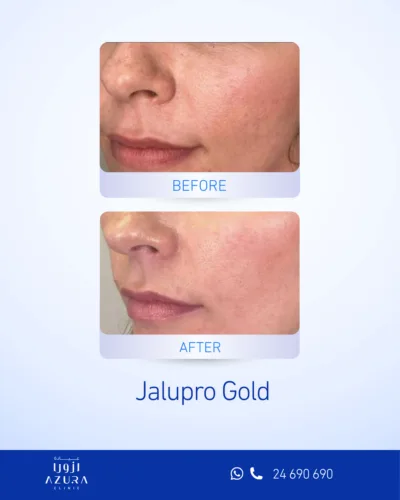 Jalupro Gold treatment at Azura Clinic Muscat to support skin hydration, elasticity, and overall skin rejuvenation.