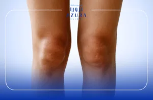 Knee Rejuvenation with Carbon Laser