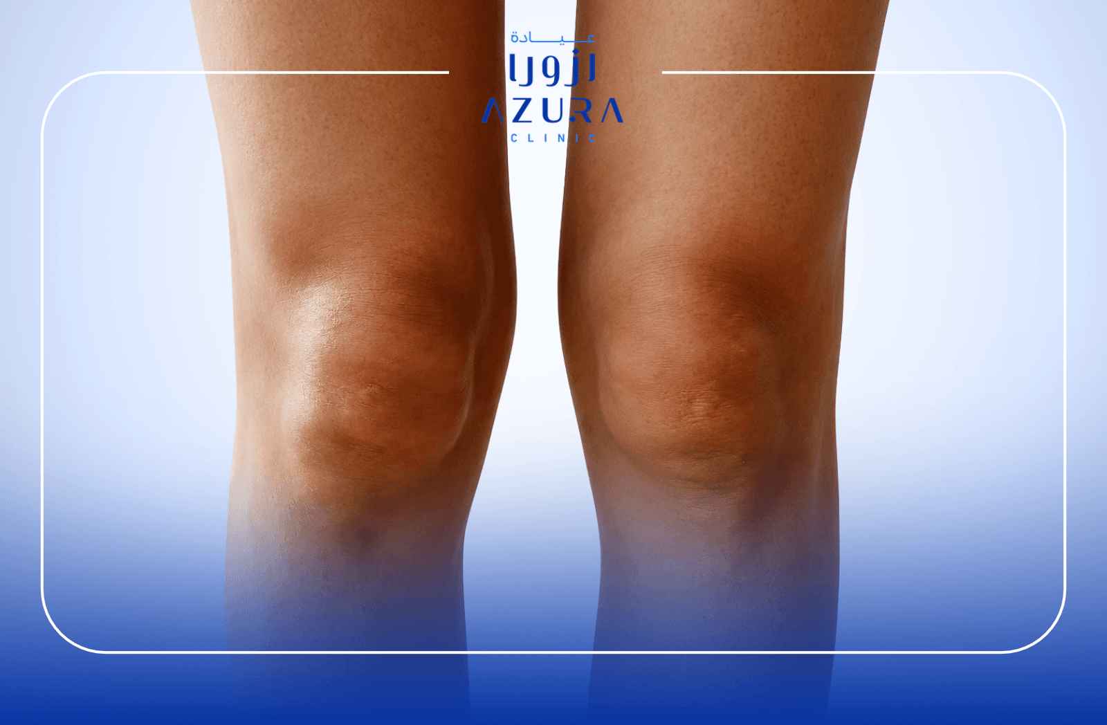 Knee rejuvenation with carbon laser treatment at Azura Clinic Muscat for smoother, firmer-looking skin.