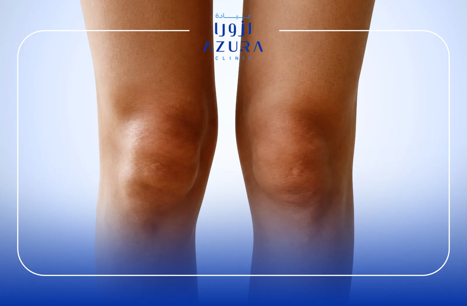 Knee rejuvenation with carbon laser treatment at Azura Clinic Muscat for smoother, firmer-looking skin.