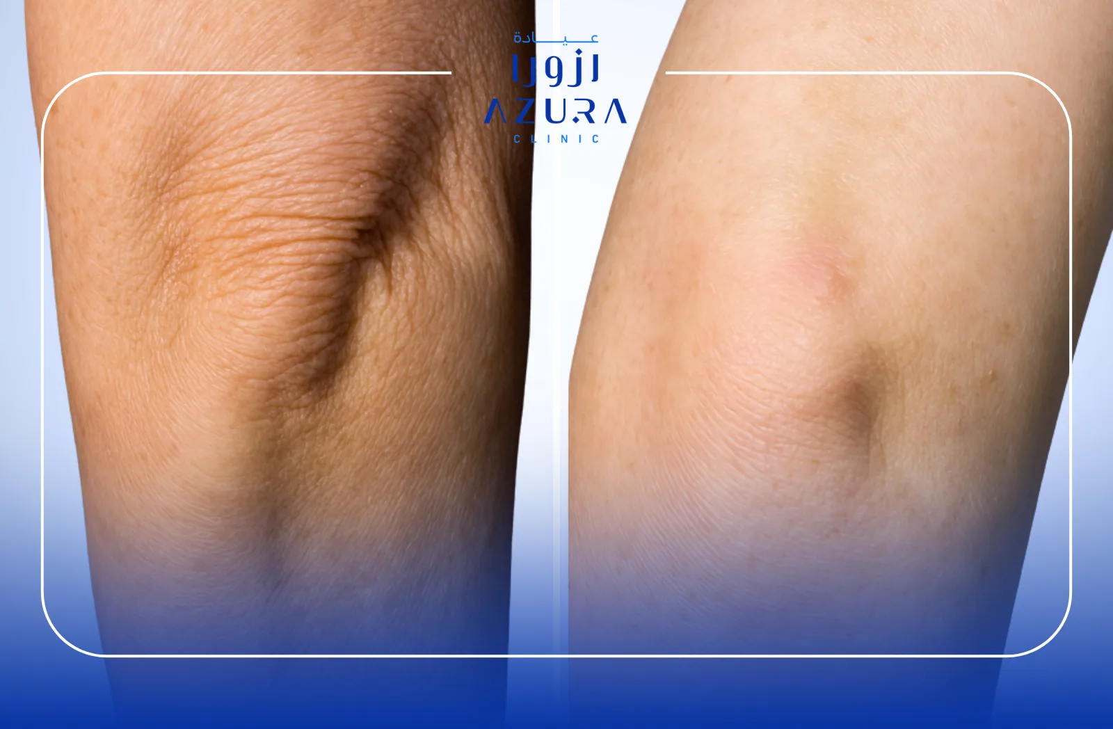 Microdermabrasion for Elbows