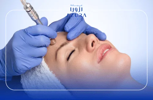 Microdermabrasion for Face
