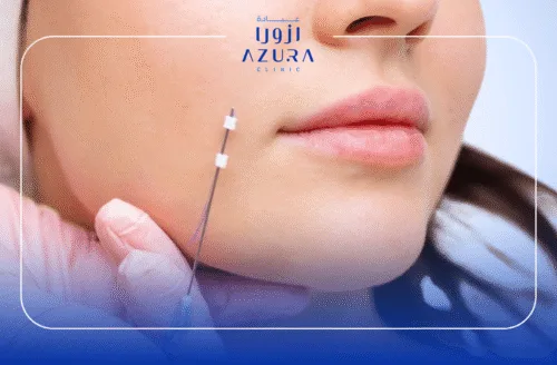 Nasolabial Folds Thread Lift