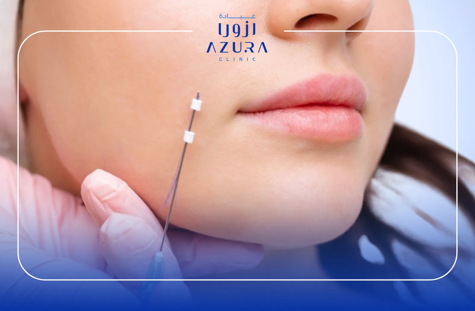 Nasolabial Folds Thread Lift