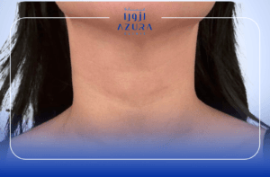 Neck rejuvenation carbon laser treatment at Azura Clinic Muscat — tighten and brighten neck skin