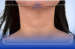 Neck Rejuvenation with Carbon Laser